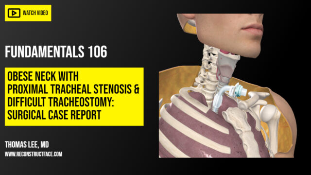Fundamentals 105: Routine Tracheostomy Surgical Technique – Facial  Reconstruction & Trauma | Surgical Atlas